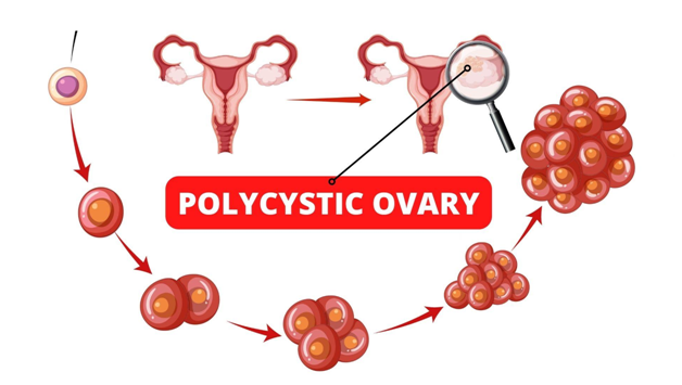 Inositol para Síndrome de Ovario Poliquístico , ¿vale la pena obtenerlo?